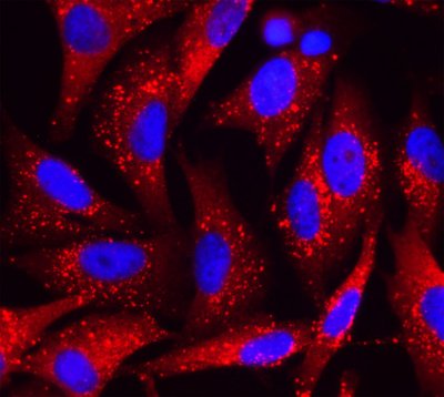 Identificación de nuevos moduladores de metástasis y mal pronóstico en el melanoma: Visualización de la proteína p62 (rojo) mediante microscopía de fluorescencia en células de melanoma. Las estructuras esféricas punteadas corresponden a grandes agregados de p62 con otras proteínas, entre ellas, factores que controlan múltiples procesos implicados en la supervivencia, proliferación e invasión de estas células tumorales. (Foto: Cnio)