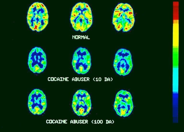 Comparación de los efectos de la cocaína en un cerebro normal, un cerebro tras consumir cocaína 10 días y un cerebro tras 100 días de consumo.