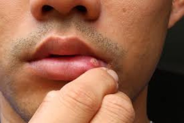 Aftas: qué hacer para prevenir.